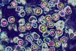 Wastewater is now helping track measles spread around the US